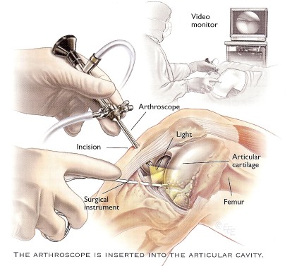 دکتر مسعود آیتی  بهترین فوق تخصص و جراح  ارتوپدی در مشهد , آرتروپلاستی arthroplasty    , تعویض مفصل هیپ و زانو  arthroscopy آرتروسکپی فلوشیپ استئوسنتز از اتریش